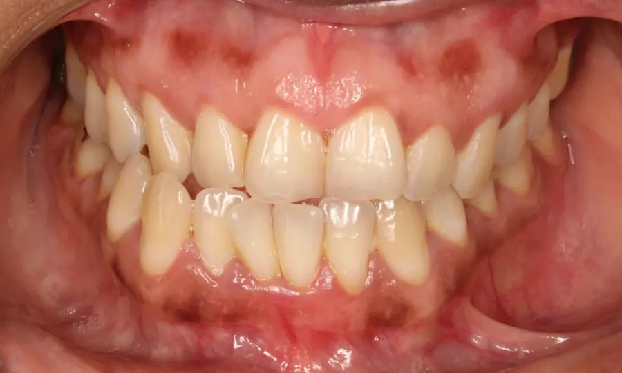 Underbite, front view, first image