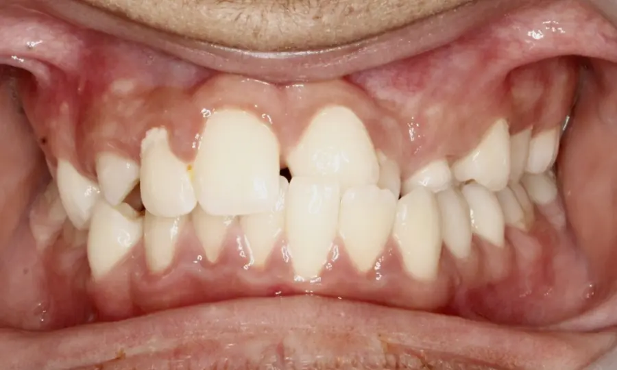 Crossbite / Impacted Canine, front view, first image