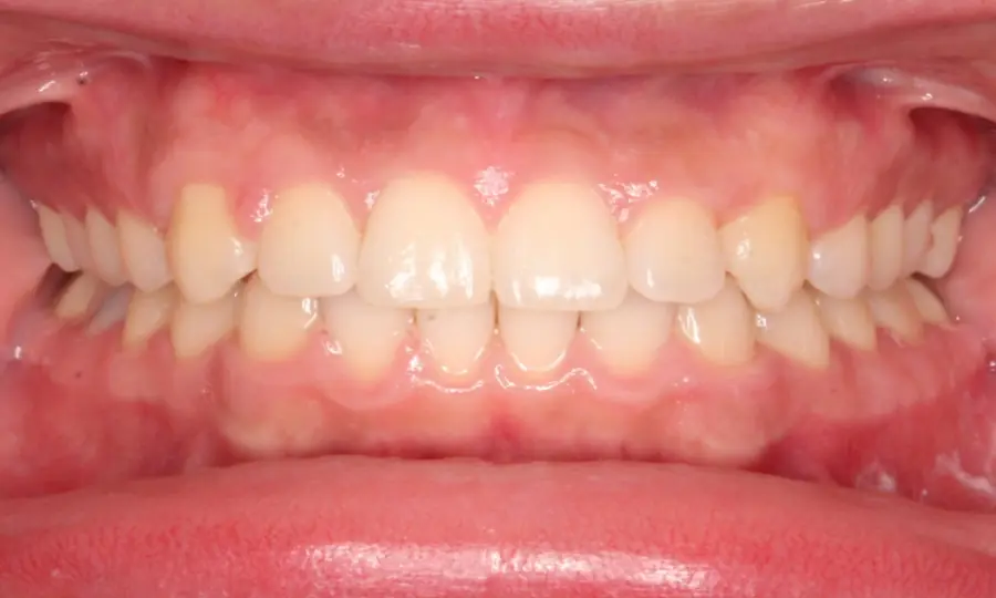 Deep Bite, front view, second image