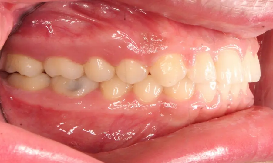 Deep Bite, left side view, second image