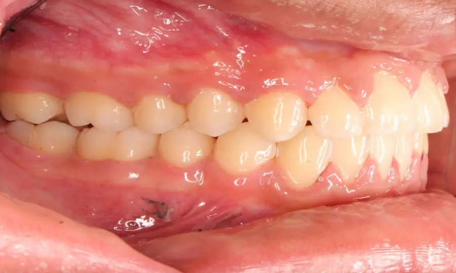 Crossbite / Impacted Canine, left side view, second image