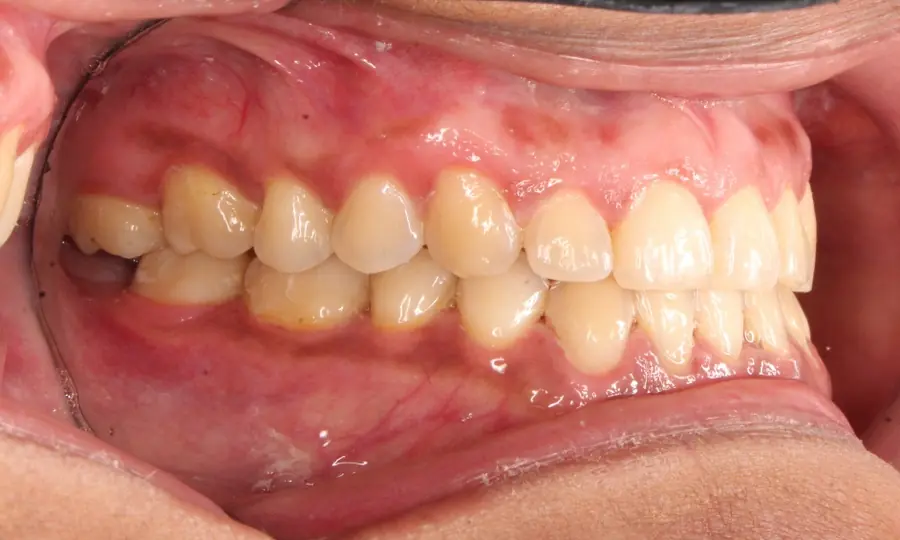 Underbite, left side view, second image