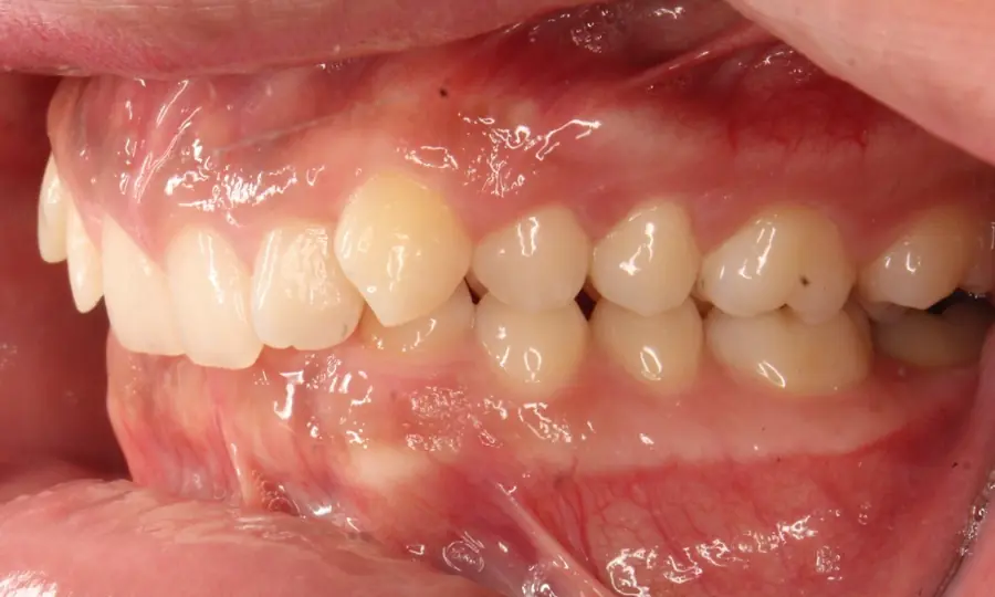 Deep Bite, right side view, first image