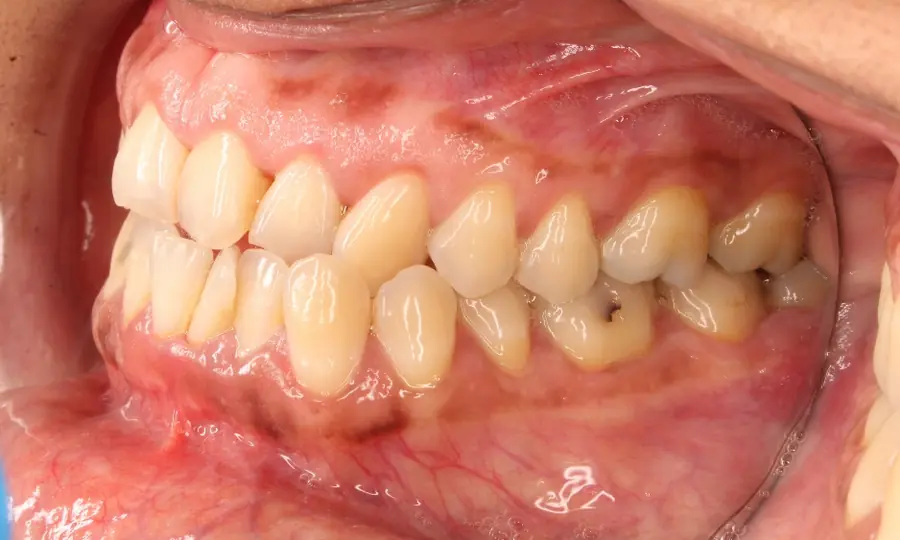 Underbite, right side view, first image