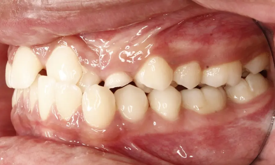 Crossbite / Impacted Canine, right side view, first image
