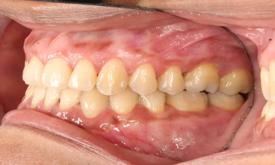 Underbite, right side view, second image